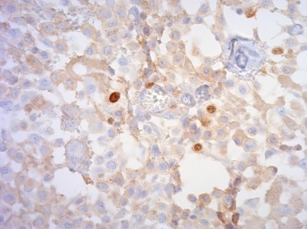 mastocytome.jpg