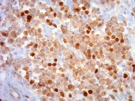 mastocytome_2.jpg